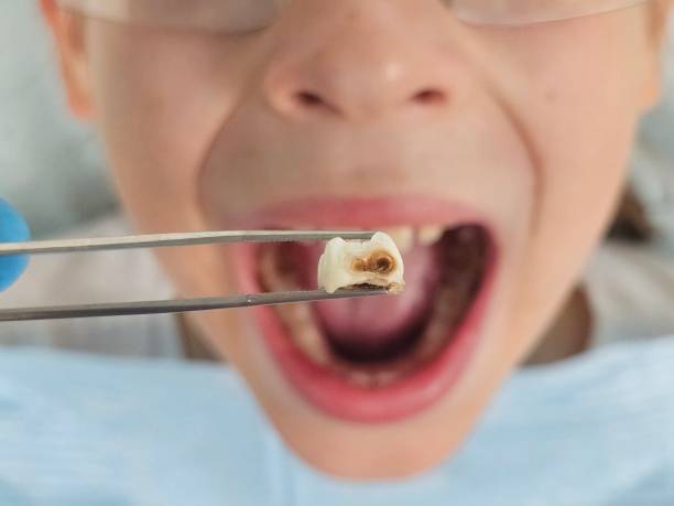Best Emergency Dental Extractions in Canton, IL